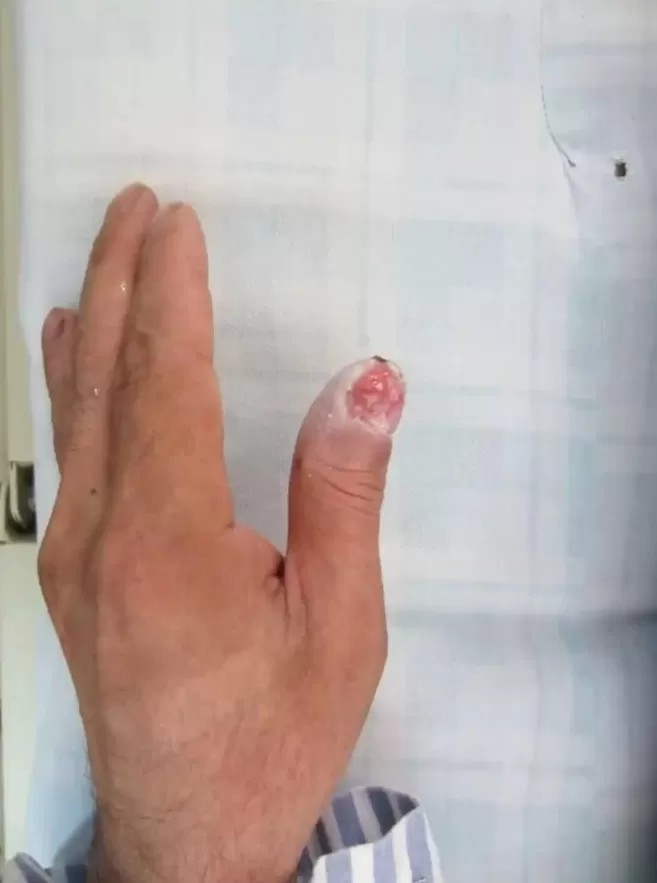 女子散步误踩氢氟酸身亡！致命“化骨水”竟可网购，烧伤救治专家发声-第3张图片-