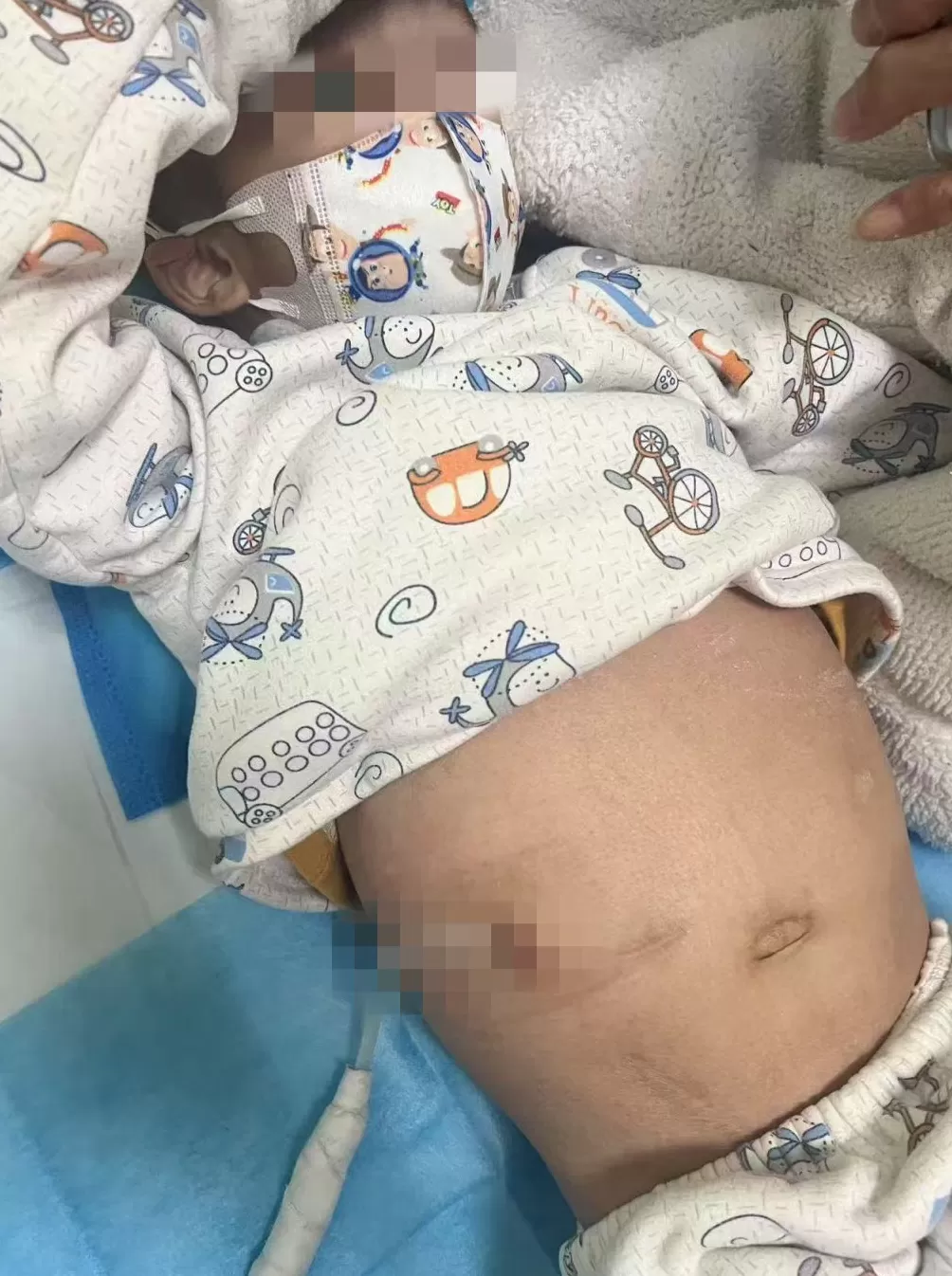 试管婴儿出生不久确诊肾病综合征：医院被判担责10%，再审后发回重审-第1张图片-