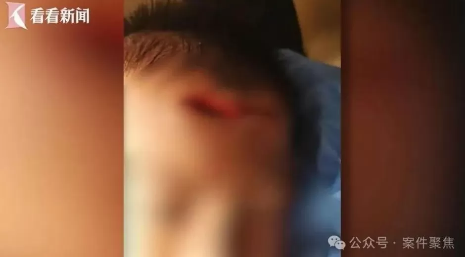 血流不止，脸上缝30多针需整容！5岁男童火锅店发生意外，谁的责任？-第2张图片-