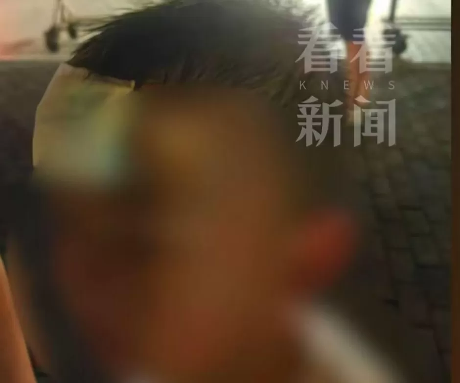 血流不止，脸上缝30多针需整容！5岁男童火锅店发生意外，谁的责任？-第3张图片-