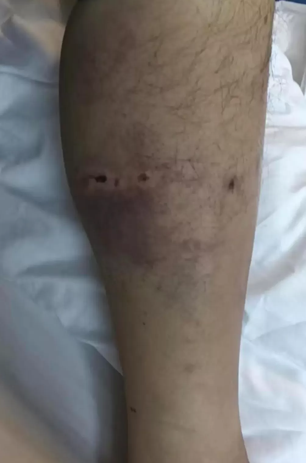 重庆男子上山采菌被黑熊袭击,“被一巴掌扇下悬崖,穿的水鞋救了自己一命”-第3张图片- 重庆男子上山采菌被黑熊袭击,“被一巴掌扇下悬崖,穿的水鞋救了自己一命”-第3张图片-