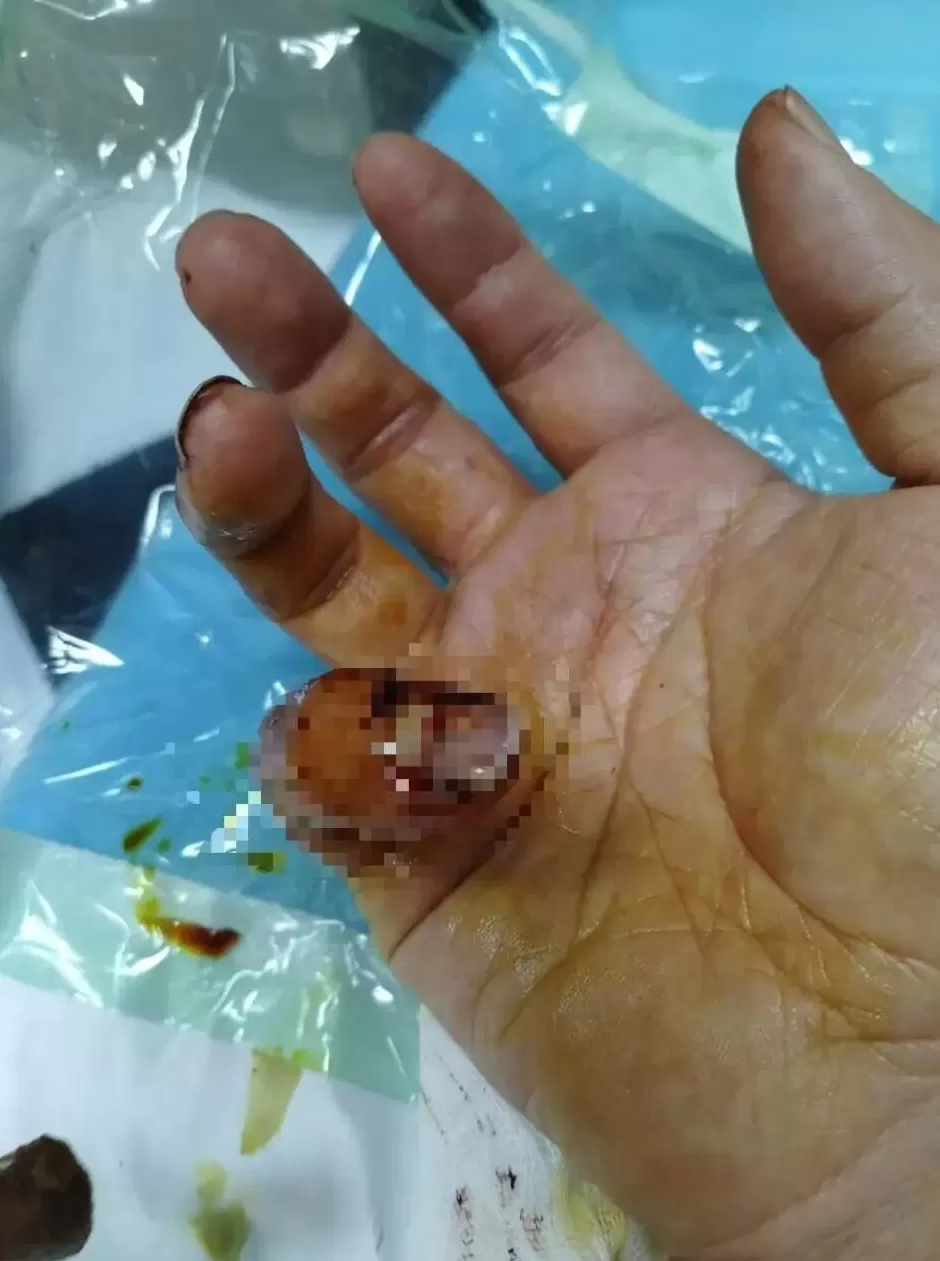理发店主阻拦城管撕广告，被城管队员咬伤手指：“别的店铺都在贴，为啥光撕我的？”兰州警方回应-第2张图片-