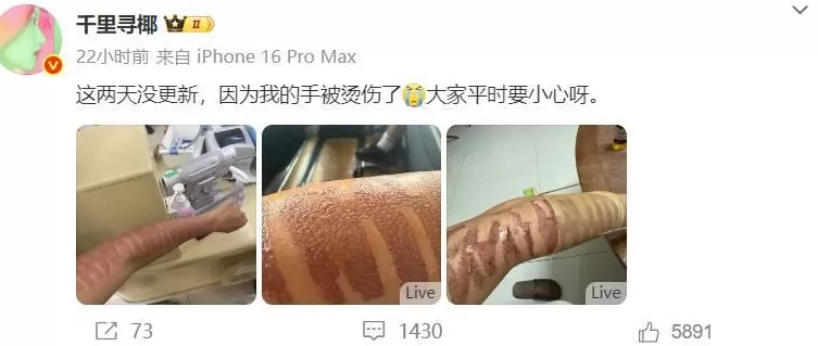 网红“千里寻椰”因光子嫩肤二度烧伤，“火辣辣的痛”持续7小时，医生：获留永久性瘢痕-第1张图片-