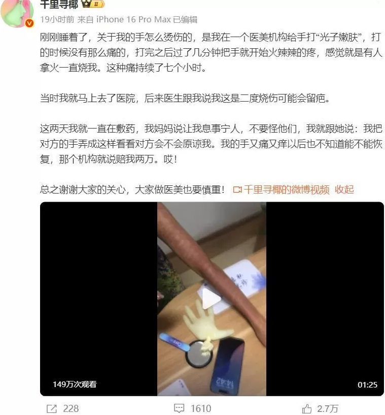 网红“千里寻椰”因光子嫩肤二度烧伤，“火辣辣的痛”持续7小时，医生：获留永久性瘢痕-第3张图片-