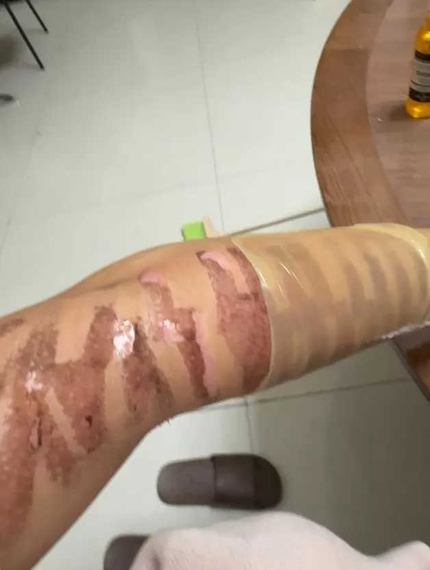 网红“千里寻椰”因光子嫩肤二度烧伤，“火辣辣的痛”持续7小时，医生：获留永久性瘢痕-第2张图片-