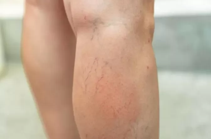 腿上出现“小蚯蚓”，别不当回事，可能被这种病盯上了-第2张图片-