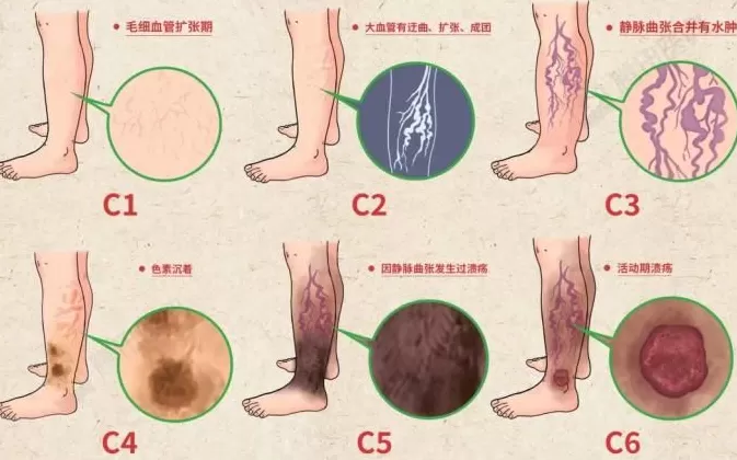 腿上出现“小蚯蚓”，别不当回事，可能被这种病盯上了-第8张图片-