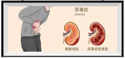 原来血液透析是这么回事！4个关键问题，帮你读懂生命守护技术|科普时间-第3张图片-