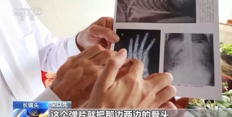 “老先生，您把项链取下来再做CT”“你看是不是弹片”-第5张图片-