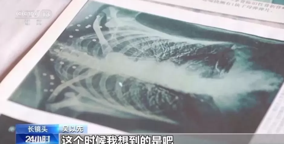 “老先生，您把项链取下来再做CT”“你看是不是弹片”-第4张图片-