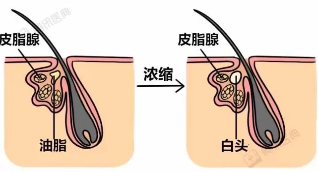 头皮抠出 “小米粒”？快住手，这几种情况要去看皮肤科-第4张图片-