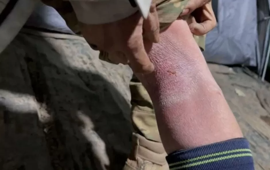 张家界荒野求生热门选手退赛,连下一周雨致腿部冻伤,本人发声:缺盐影响冻伤愈合-第3张图片- 张家界荒野求生热门选手退赛,连下一周雨致腿部冻伤,本人发声:缺盐影响冻伤愈合-第3张图片-