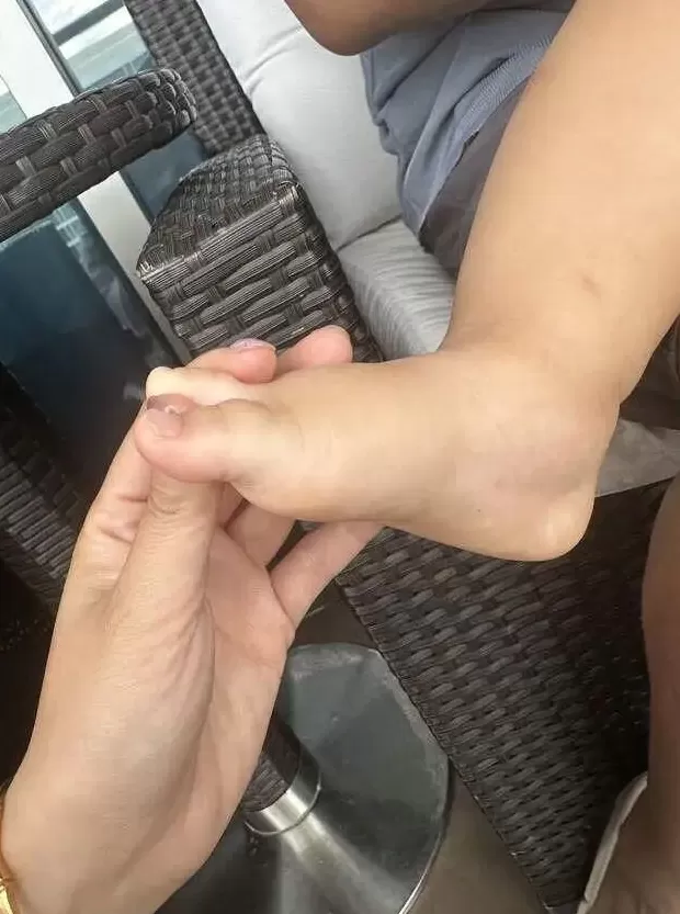 婆孙在泳池边被毒虫咬伤,酒店称虫子是从外面飞进来的,跟酒店没关系!多方最新回应-第2张图片- 婆孙在泳池边被毒虫咬伤,酒店称虫子是从外面飞进来的,跟酒店没关系!多方最新回应-第2张图片-