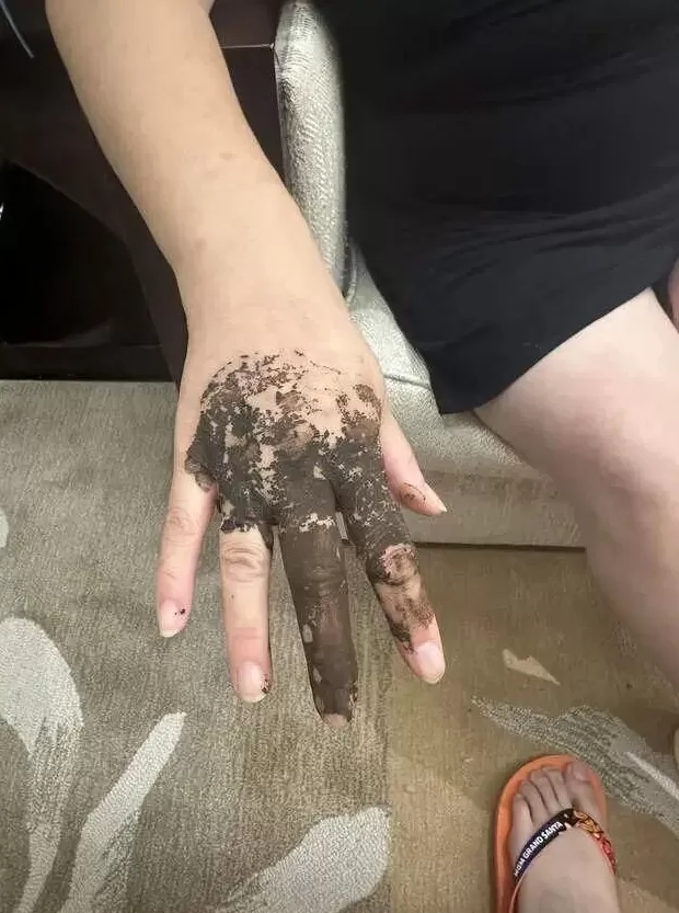 婆孙在泳池边被毒虫咬伤,酒店称虫子是从外面飞进来的,跟酒店没关系!多方最新回应-第4张图片- 婆孙在泳池边被毒虫咬伤,酒店称虫子是从外面飞进来的,跟酒店没关系!多方最新回应-第4张图片-