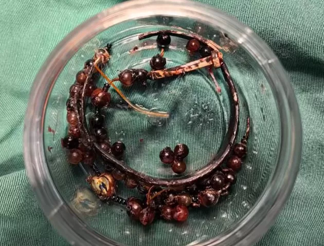 女子手镯10年没摘竟“长”进肉里！医生：再迟就保不住了-第3张图片-