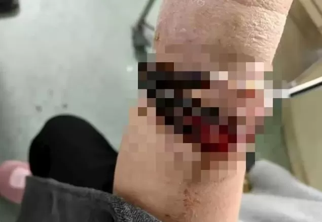 女子手镯10年没摘竟“长”进肉里！医生：再迟就保不住了-第1张图片-