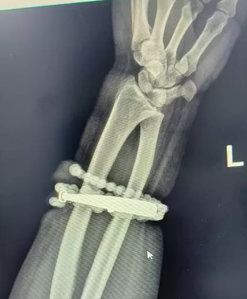 女子手镯10年没摘竟“长”进肉里！医生：再迟就保不住了-第2张图片-