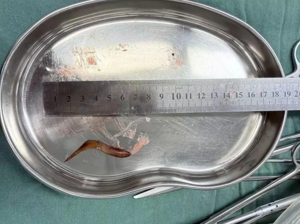 男子甲鱼骨卡喉吞饭“自救”致腹腔感染医生紧急提醒-第1张图片- 男子甲鱼骨卡喉吞饭“自救”致腹腔感染医生紧急提醒-第1张图片-