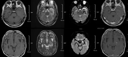 30岁小伙长期熬夜智力退回3岁年轻人患“脑膜炎”病例为何频发？-第4张图片-