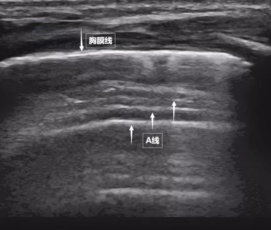 无声的声波有形的肺-第2张图片- 无声的声波有形的肺-第2张图片-