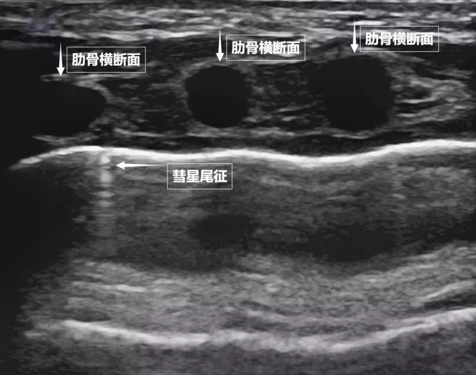 无声的声波有形的肺-第3张图片- 无声的声波有形的肺-第3张图片-