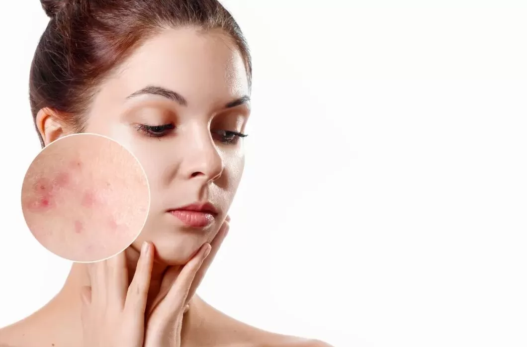 警报!你的脸蛋是否正在启动“秋冬崩盘”模式?-第3张图片- 警报!你的脸蛋是否正在启动“秋冬崩盘”模式?-第3张图片-