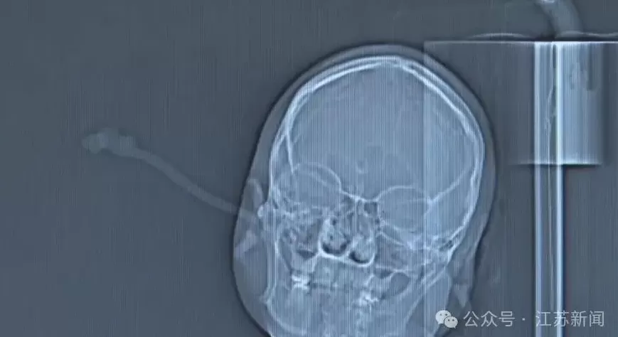 女子睡前“偷懒”没摘发饰，夜里插入耳朵直抵后脑勺！医生：并非个例-第3张图片-