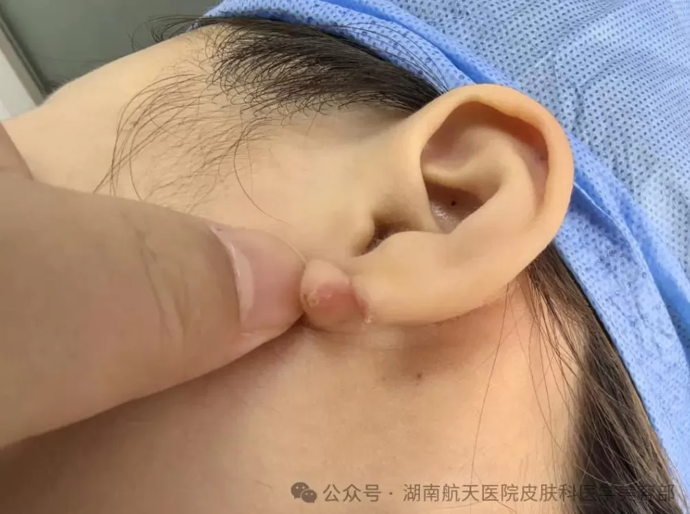 女子睡前“偷懒”没摘发饰，夜里插入耳朵直抵后脑勺！医生：并非个例-第4张图片-