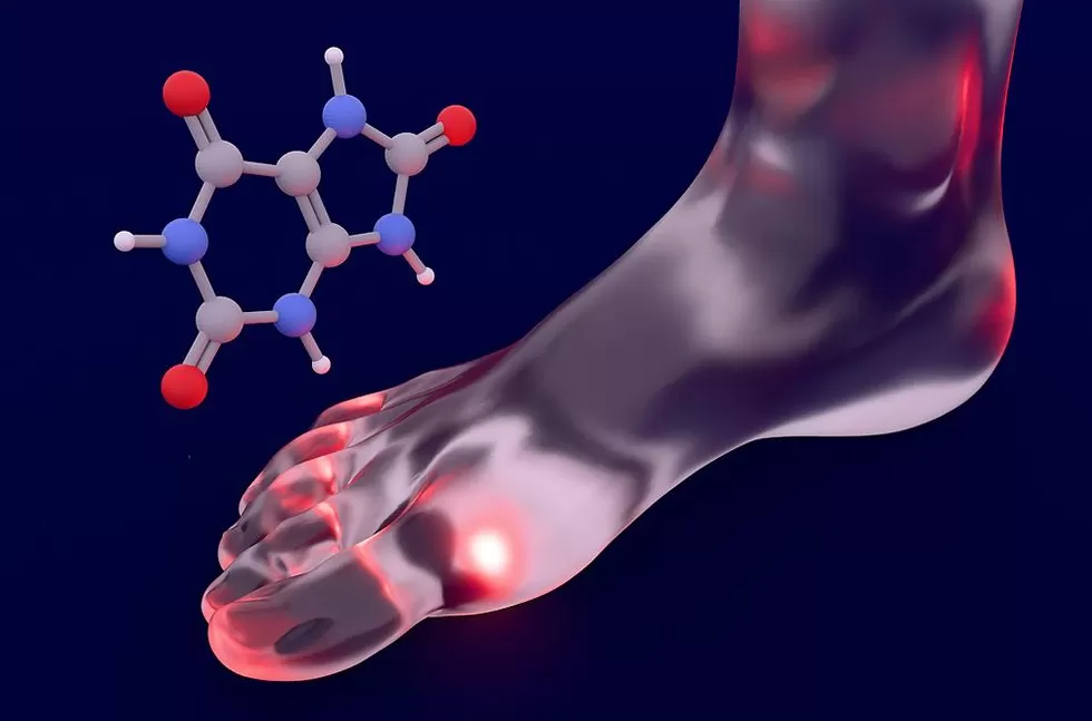 科普｜年轻人也要警惕痛风，管住嘴是基础，规范治疗是关键-第1张图片-