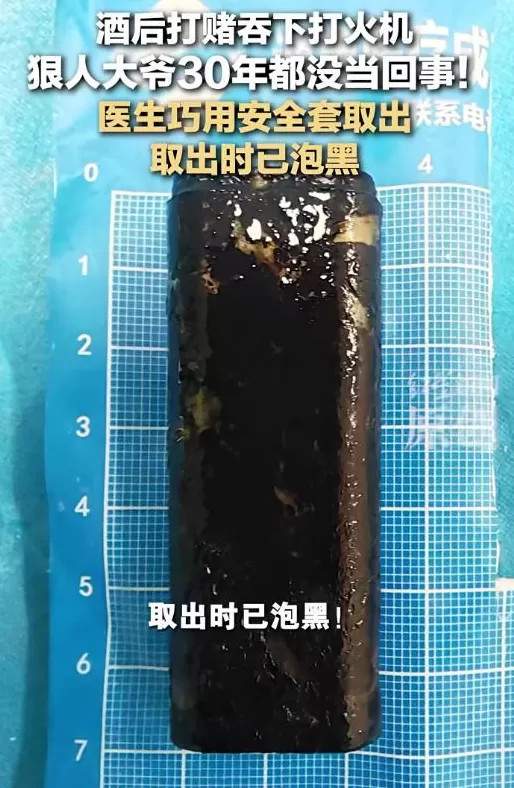 大爷酒后打赌吞下打火机，30年都没当回事！医生用安全套取出-第1张图片-