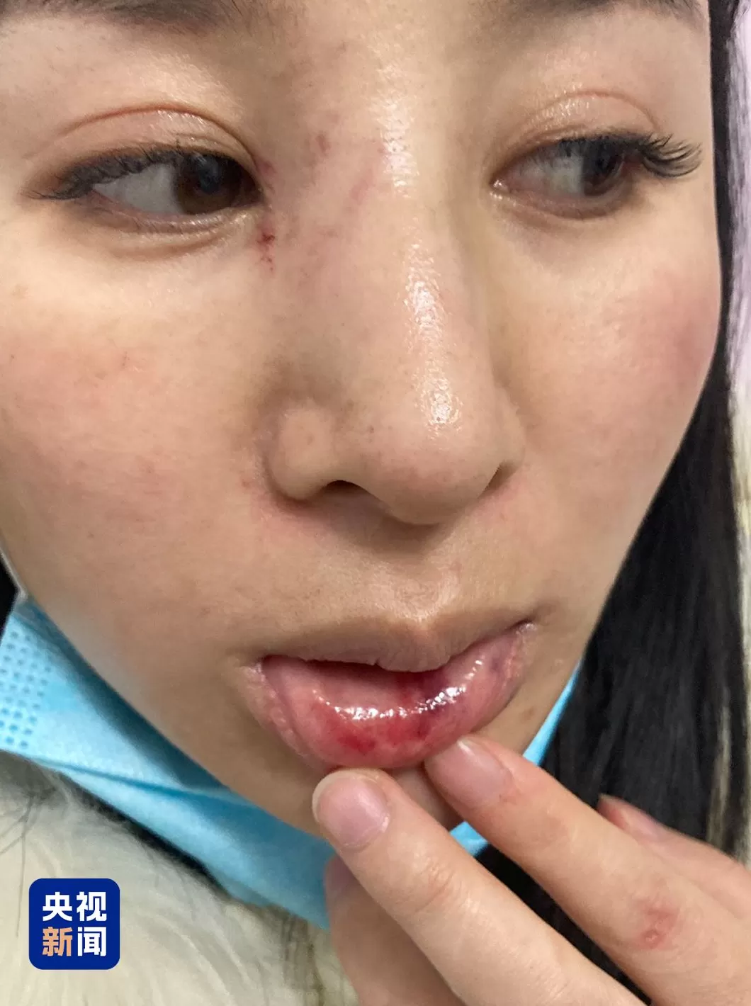 专访丨两年被家暴16次，4处重伤！受害者是否走出阴霾？-第2张图片-